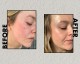 کرم ضدلک اوردینری مدل azelaic acid 10% کرم ضدلک اوردینری مدل azelaic acid 10%