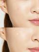 پج آکنه کوزارکس مدل pimple master پج آکنه کوزارکس مدل pimple master